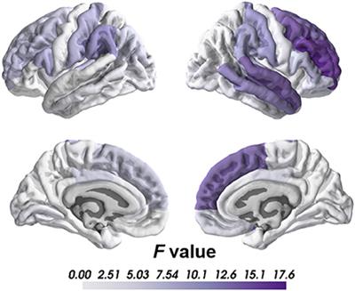 Negative symptoms correlate with altered brain structural asymmetry in amygdala and superior temporal region in schizophrenia patients